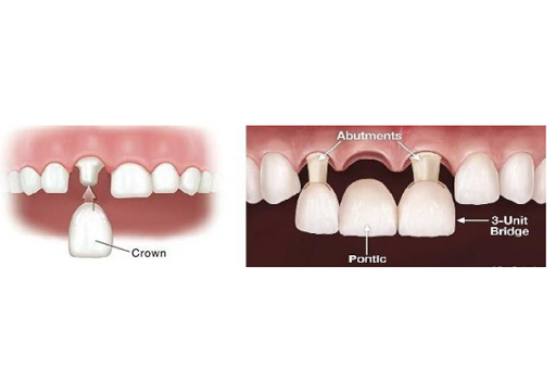 Crowns and Fixed Partial Dentures
